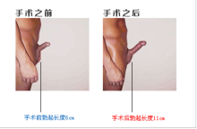 阴茎短小会影响生育吗?