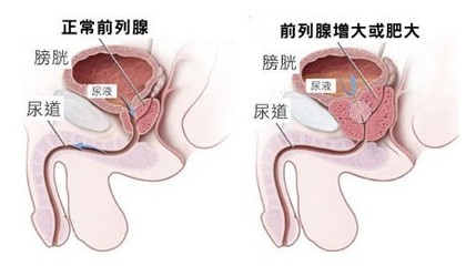 前列腺肥大的危害有哪些
