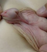尿道下裂的危害都有哪些