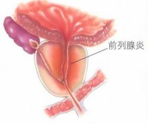 前列腺炎的危害有哪些?