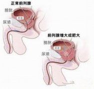 前列腺增生的一般症状是什么