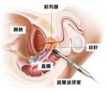 哪些是导致前列腺增大的原因