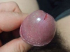 引起包皮龟头炎的病因有哪些