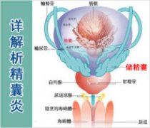 男性患上急性精囊炎怎么办