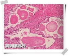 哪些因素容易引起前列腺结石?