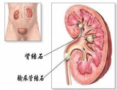男性输尿管结石是怎样形成的?