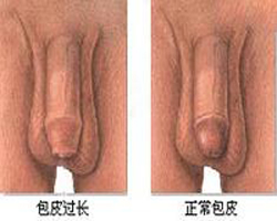 专家解读男人包皮过长的病因